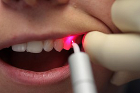 Лечение кист зубов