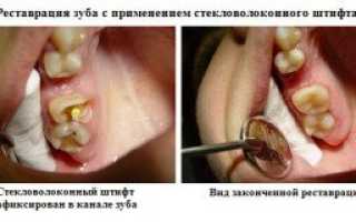 Восстановление разрушенного зуба при оставшемся корне
