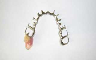 Виды креплений бюгельных протезов, фото, сравнение цен