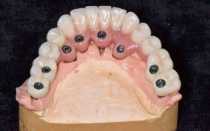 Какие виды съемных протезов лучше