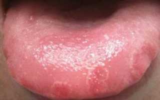 Язвы на языке: почему возникают и как их лечить?