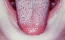 Красные пупырышки на разных участках языка