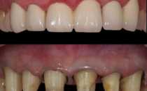 Пластмассовые коронки на передние зубы