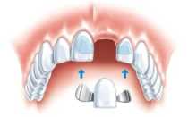 Адгезивное протезирование зубов